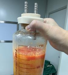射洪水动力吸脂手术要做多久？